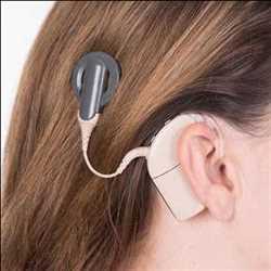 Global Cochlear Implants Market