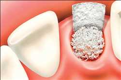 Global Dental Bone Graft Substitutes Market