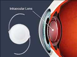 Global Intraocular Lens Market