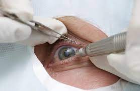 Global Retinal Surgery Devices Market