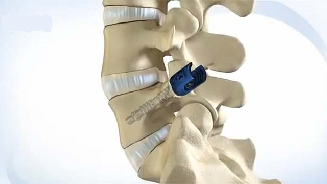 Global Spine Surgery Devices Market Revenue to Cross USD 2.98 Billion by 2027