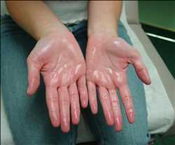 Global Hyperhidrosis Treatment Market demand